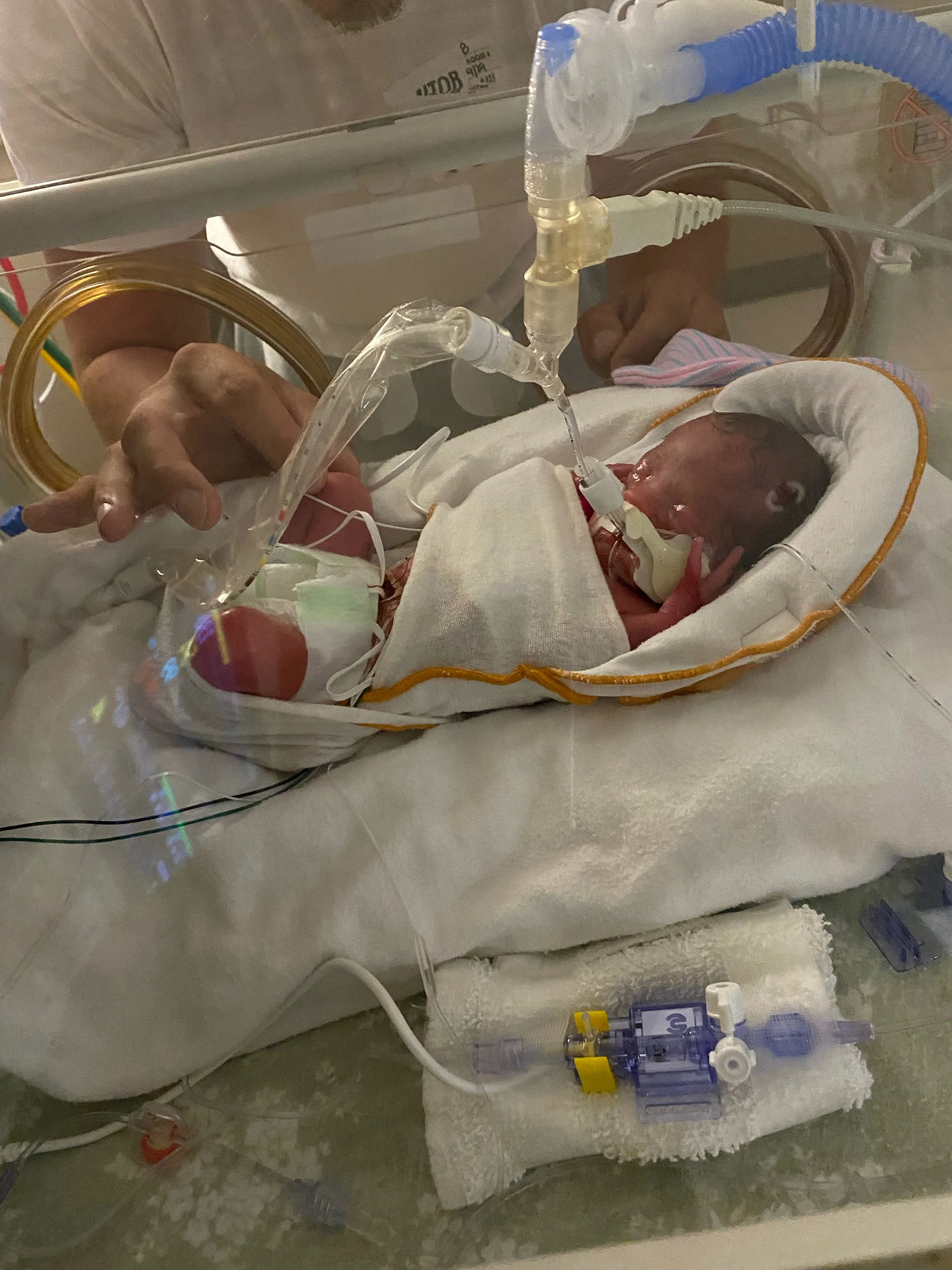 Premature baby in an incubator with tubes and medical equipment, being gently touched by an adult hand.