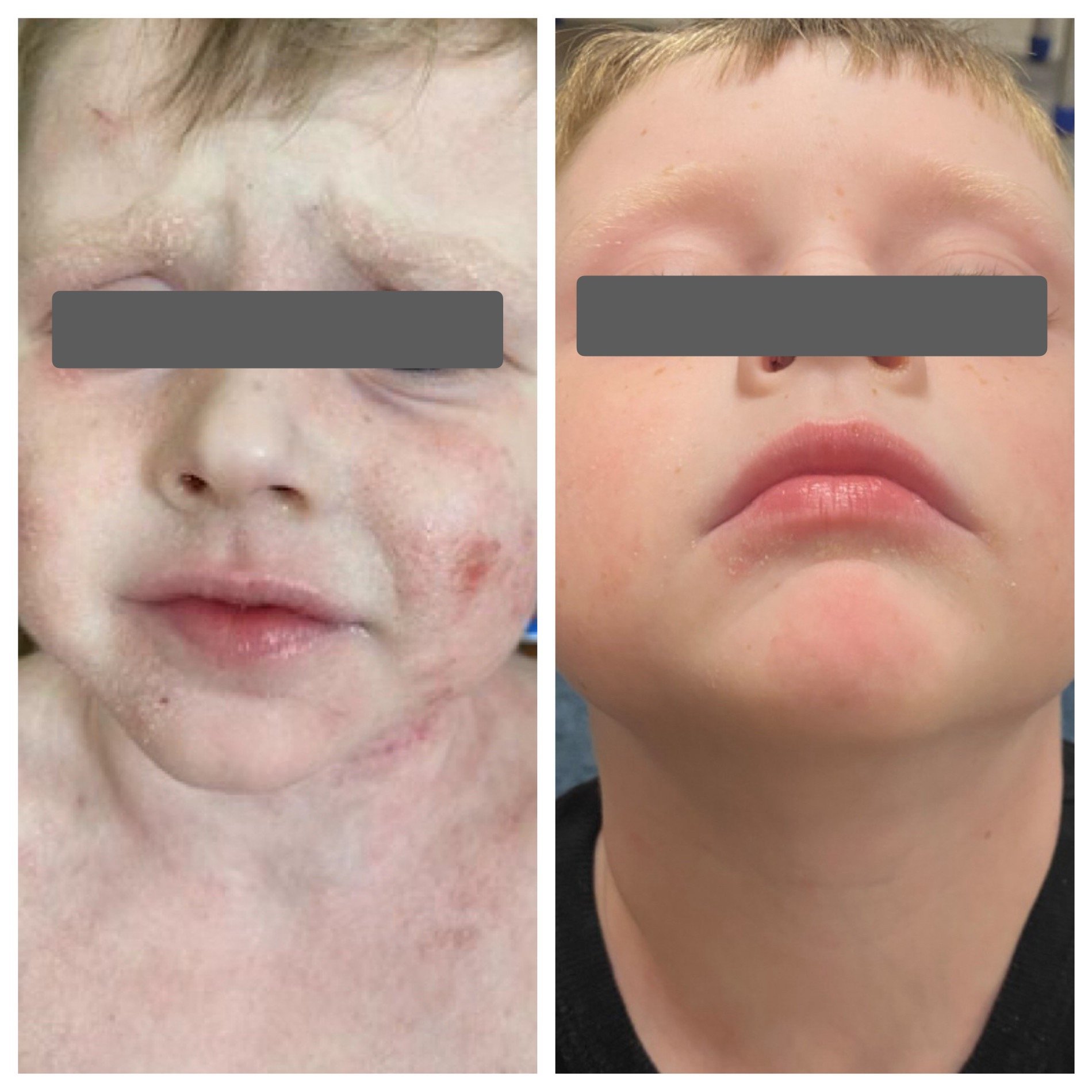 Side-by-side comparison of a child's face showing skin before and after treatment; left side shows skin with eczema and red spots, right side shows clear skin with no visible blemishes.