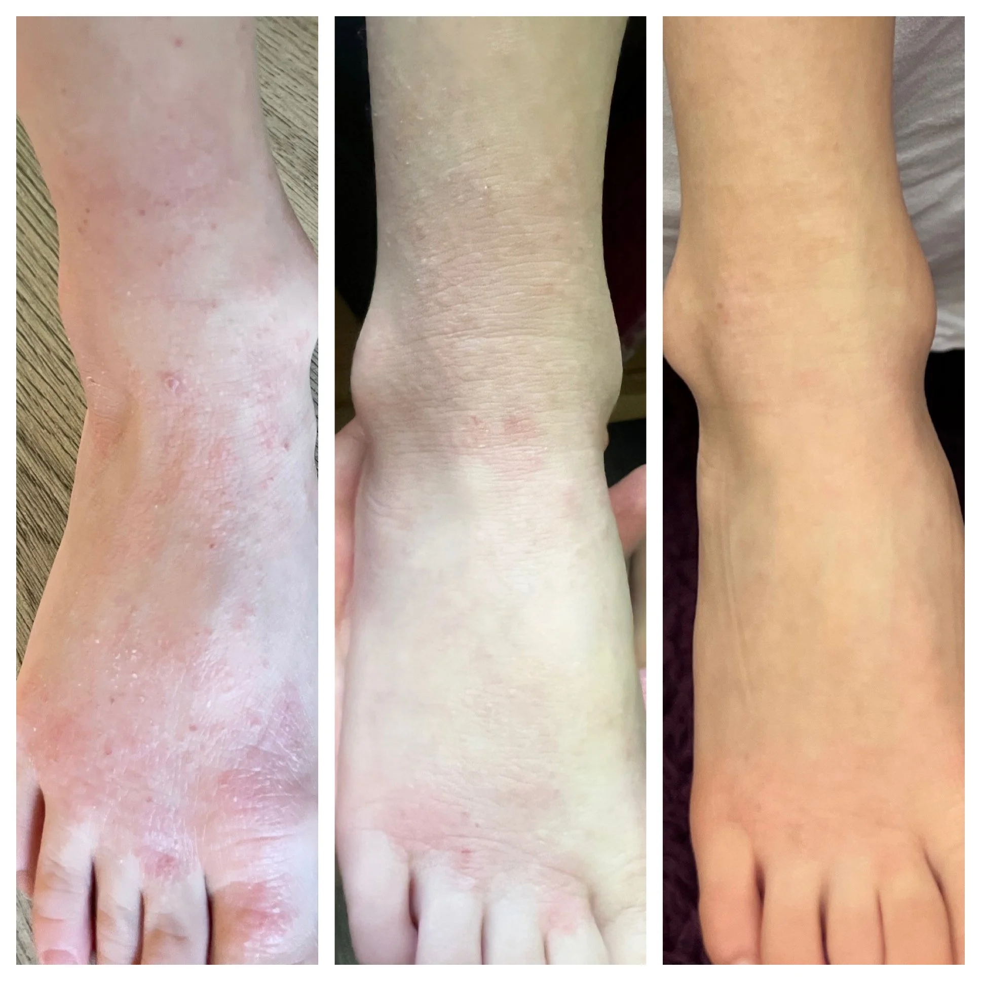 Progression of a person's foot condition showing before, during, and after treatment, with dry, peeling skin on the left, improved skin in the middle, and smooth skin on the right.