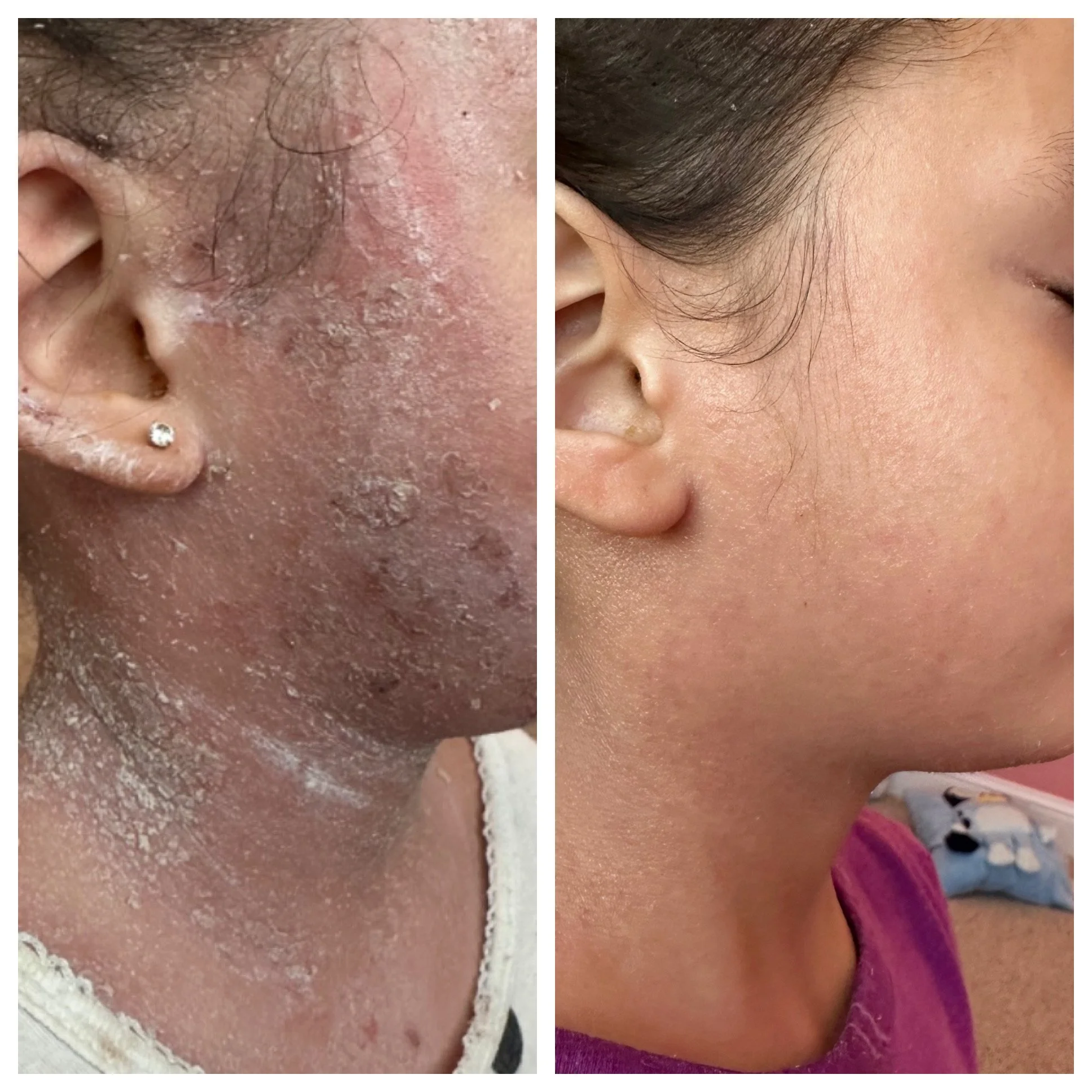 Side-by-side comparison of a woman's face showing severe skin dryness and irritation on the left, and clear, smooth skin on the right.