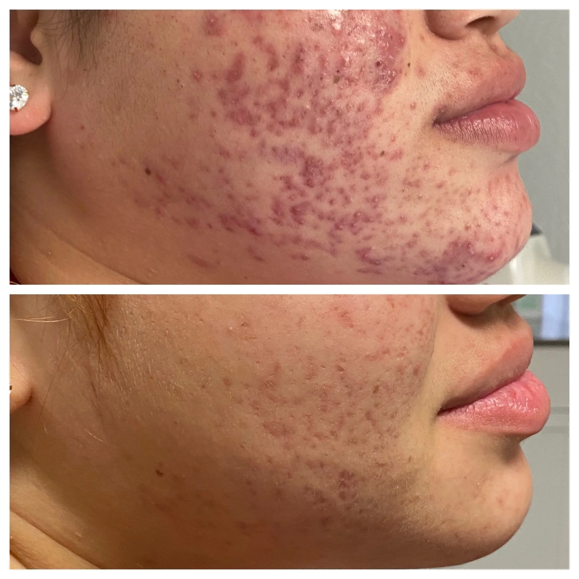 Side-by-side comparison of a person's cheek before and after acne treatment showing significant improvement in skin condition.