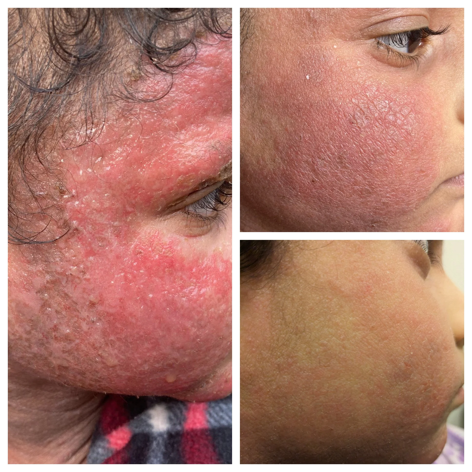 Comparison of facial skin showing severe eczema on the left, moderate redness and inflammation on the top right, and clearer skin on the bottom right.