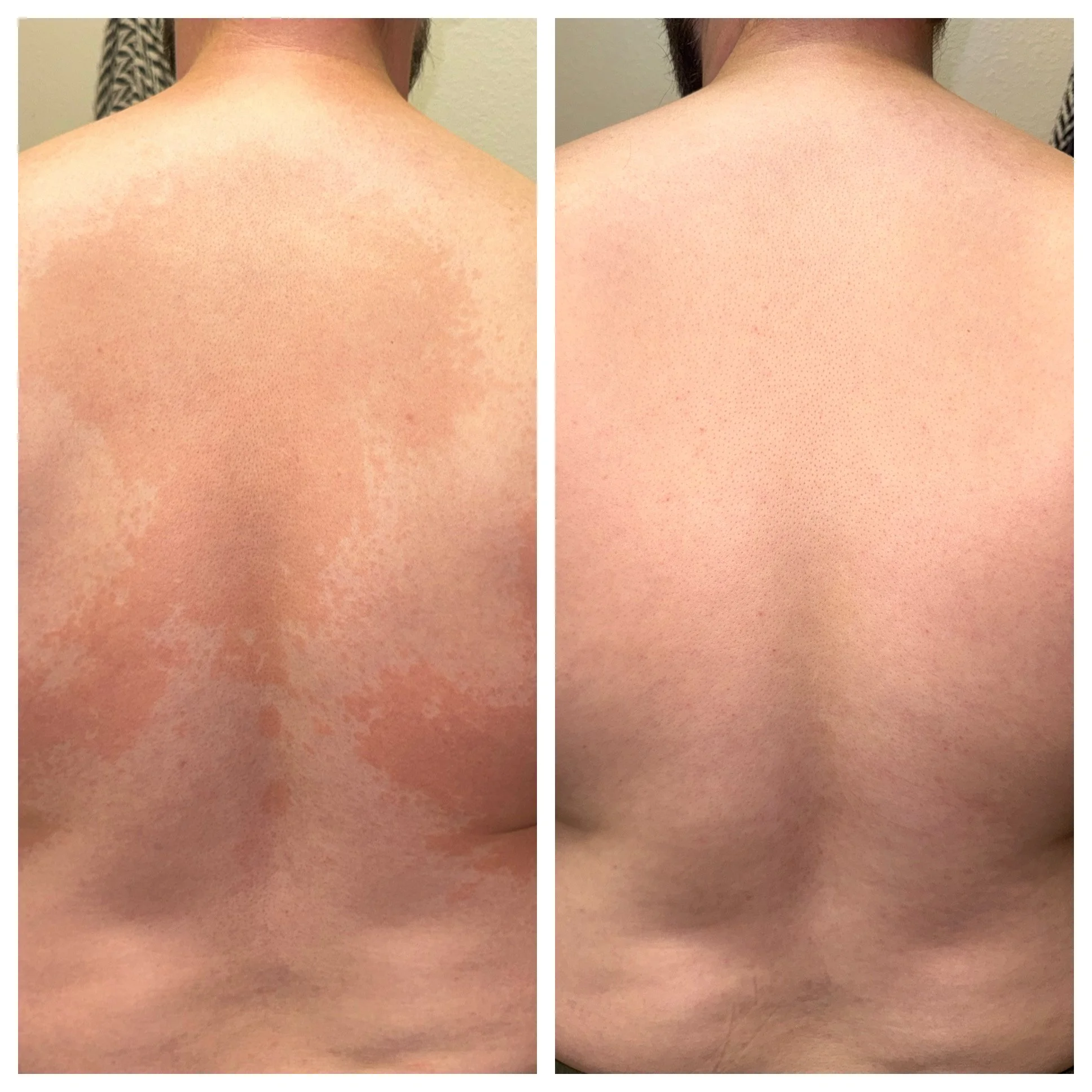 Side-by-side comparison of a person's back before and after treatment for tinea versicolor and skin condition improvement.