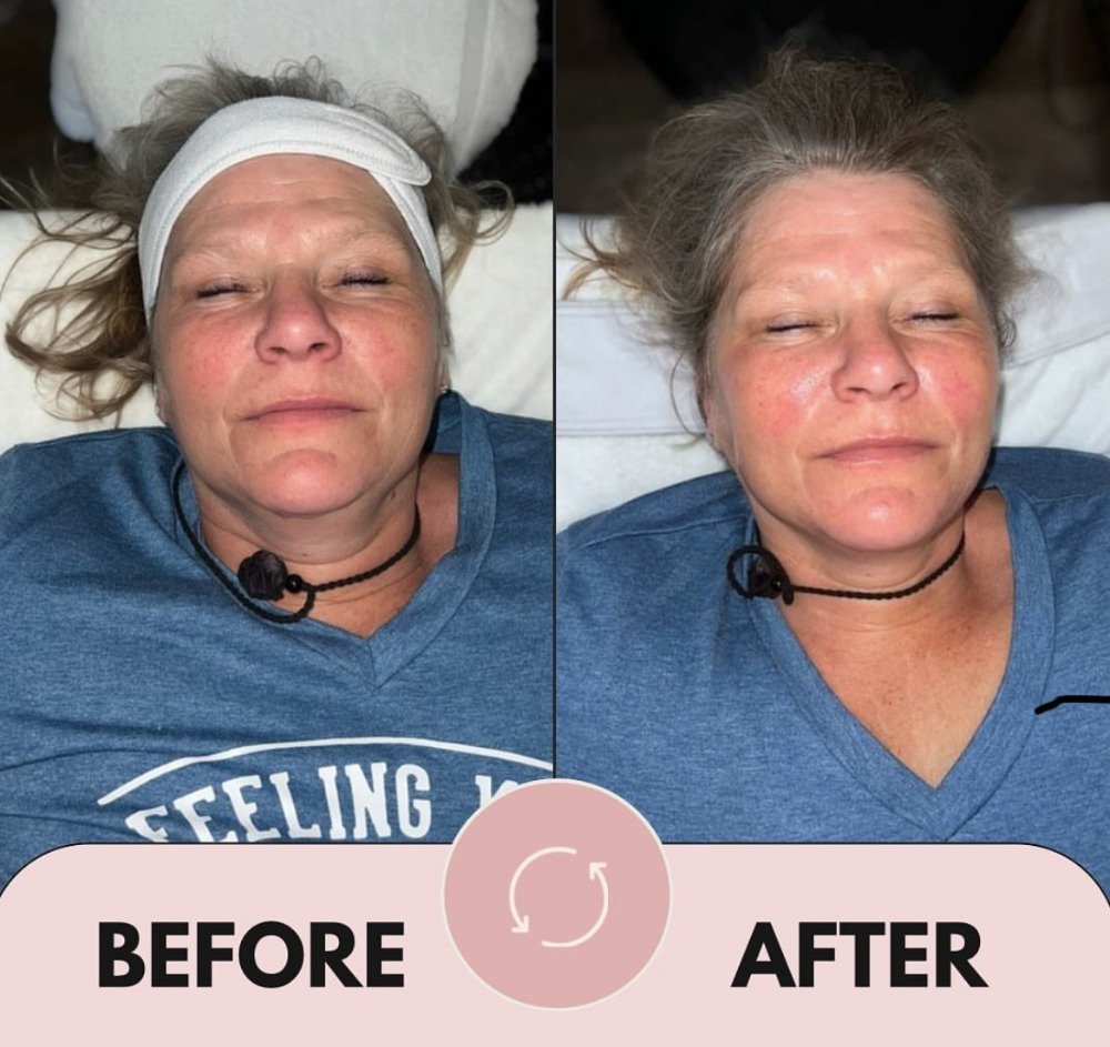 MICRODERMABRASION facial.