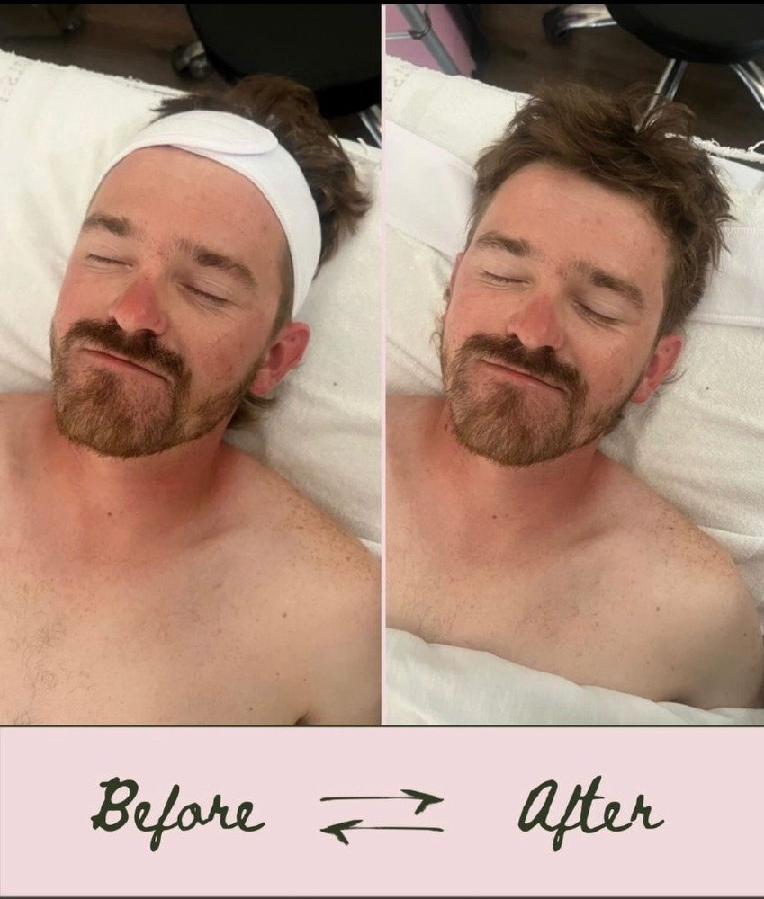 MICRODERMABRASION facial.