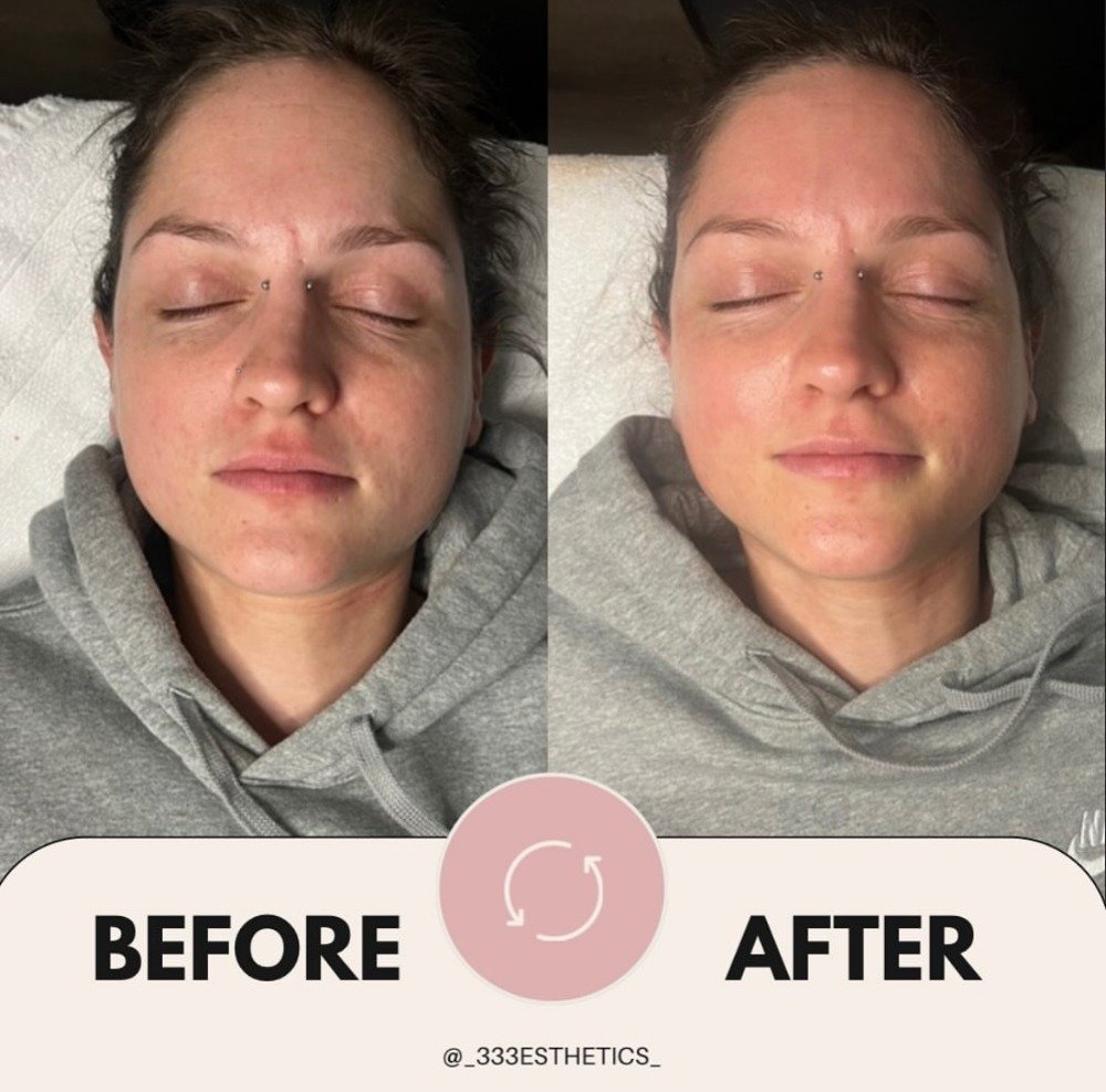CHEMICAL PEEL treatment using Image Skincare 02 Lift.