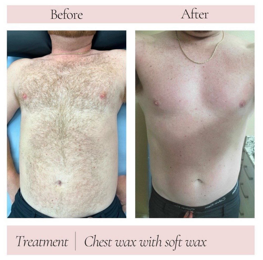 FULL CHEST WAX using a mix of soft wax and hard wax.