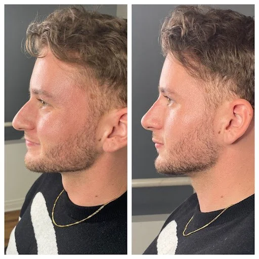 HA nose 2.jpg