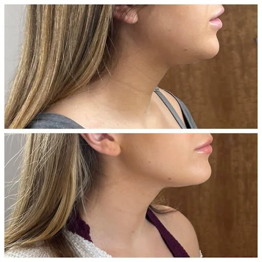 kybella4.jpg