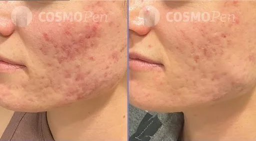 4. microneedling.jpg