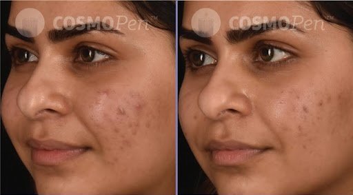 5. microneedling.jpg