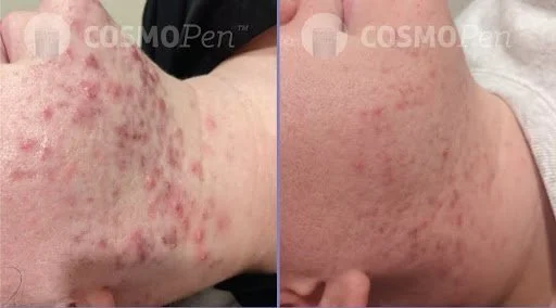 1. microneedling.jpg