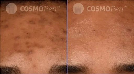 6. microneedling.jpg