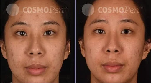 3. microneedling.jpg