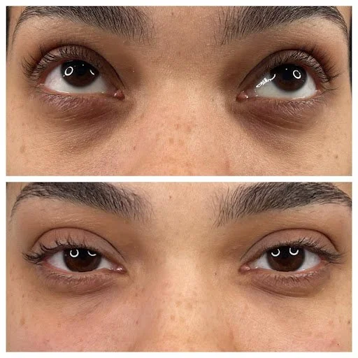 HA undereye 3.jpg