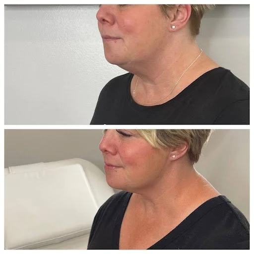 kybella3.jpg
