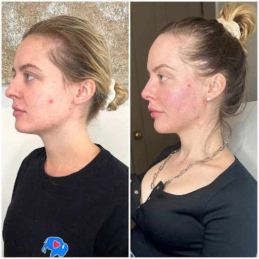 sculptra new.jpg