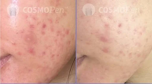 2. microneedling.jpg