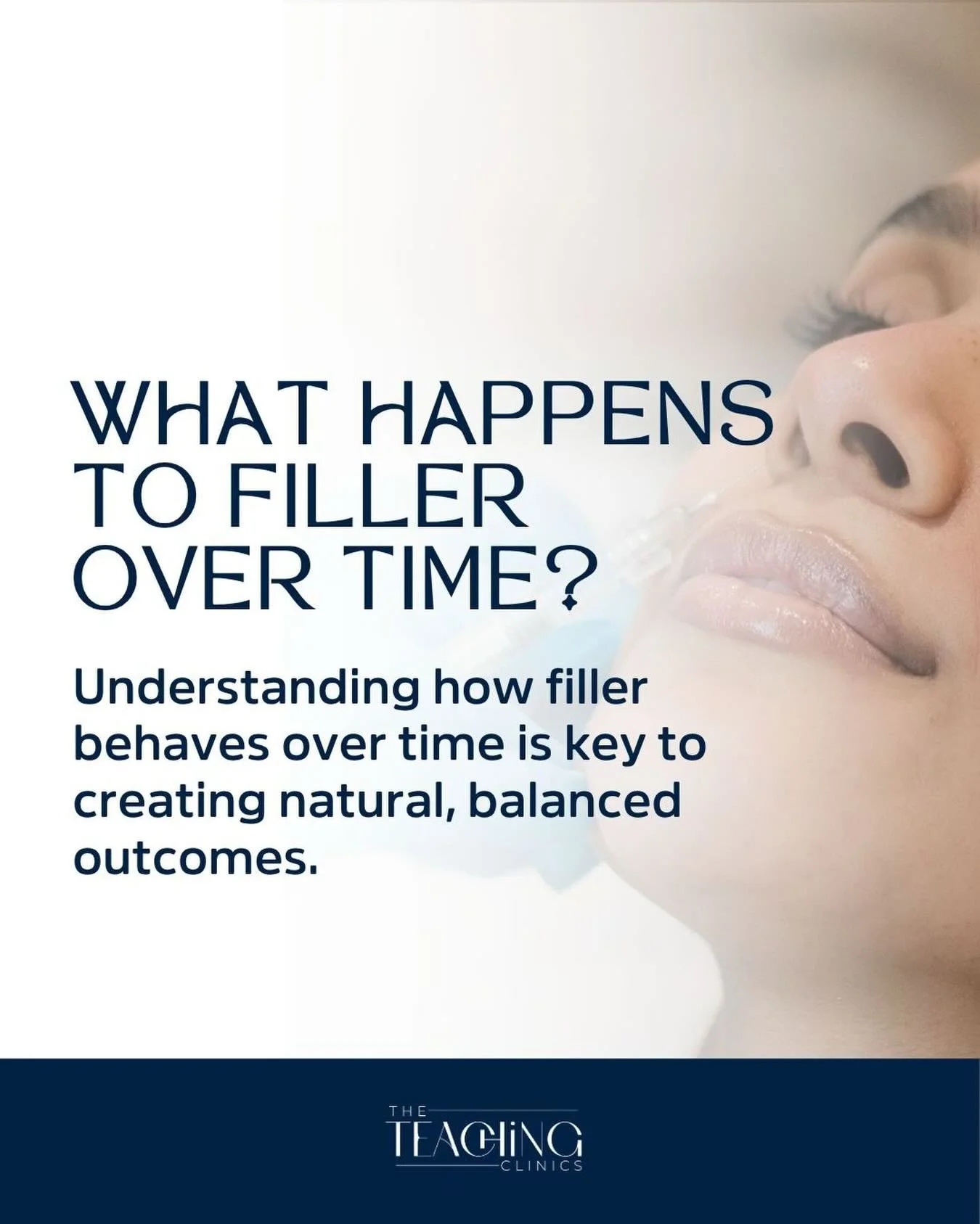 Filler doesn&rsquo;t just &ldquo;sit&rdquo; in the face.
Over time, it integrates with the surrounding tissue, gradually breaking down as the body metabolises it.

The rate of this process varies depending on the product used, the area treated, and i