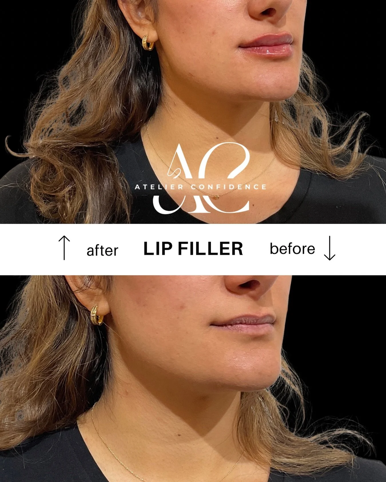 Because you deserve lips that you can&rsquo;t stop smiling about 😊 
Our lip filler treatments are designed for natural results&mdash;more balance, more confidence, more YOU. Book your consultation today. 
#LipFillerBrooklyn #NaturalLips #poweredbypo