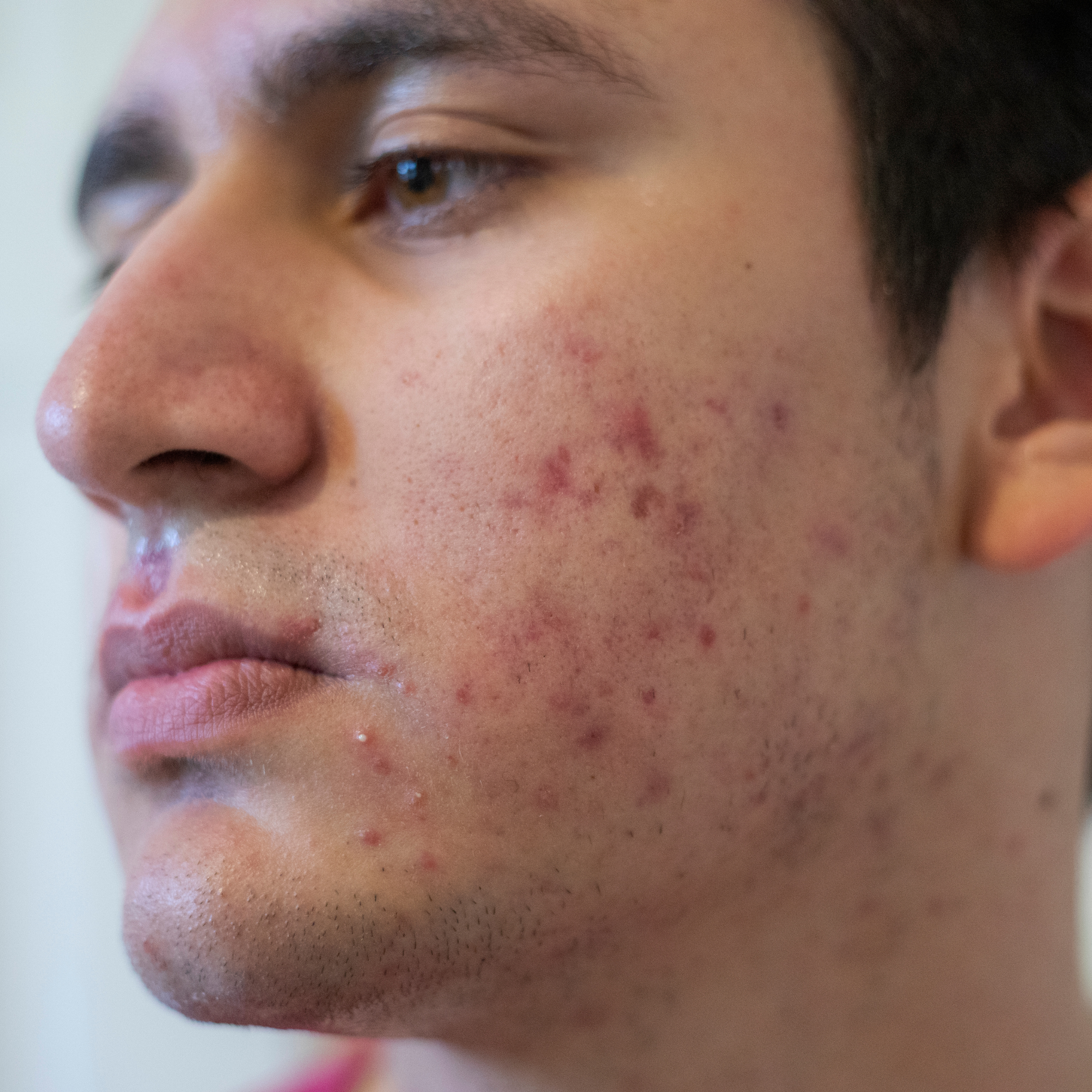 man's cheek displaying acne, inflamed skin, and hyperpigmentation