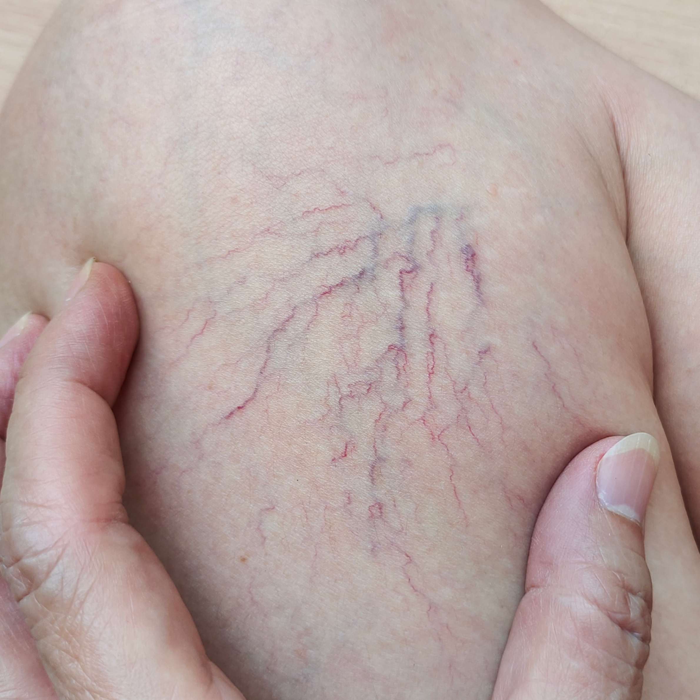 red and blue blood vessels