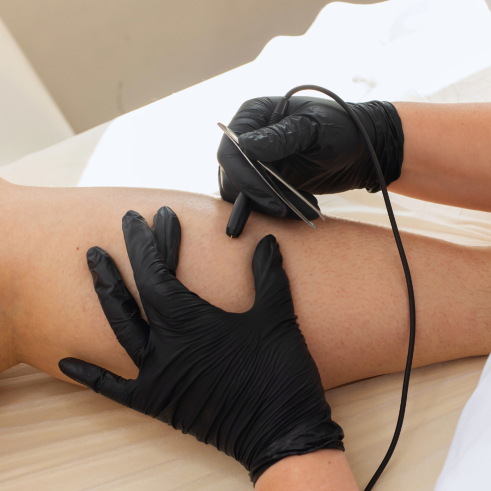 black gloved hands preforming electrolysis treatment