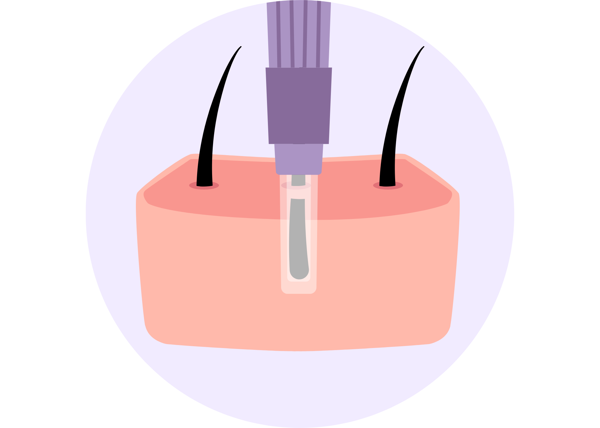 black hair follicle getting zapped by a purple laser light