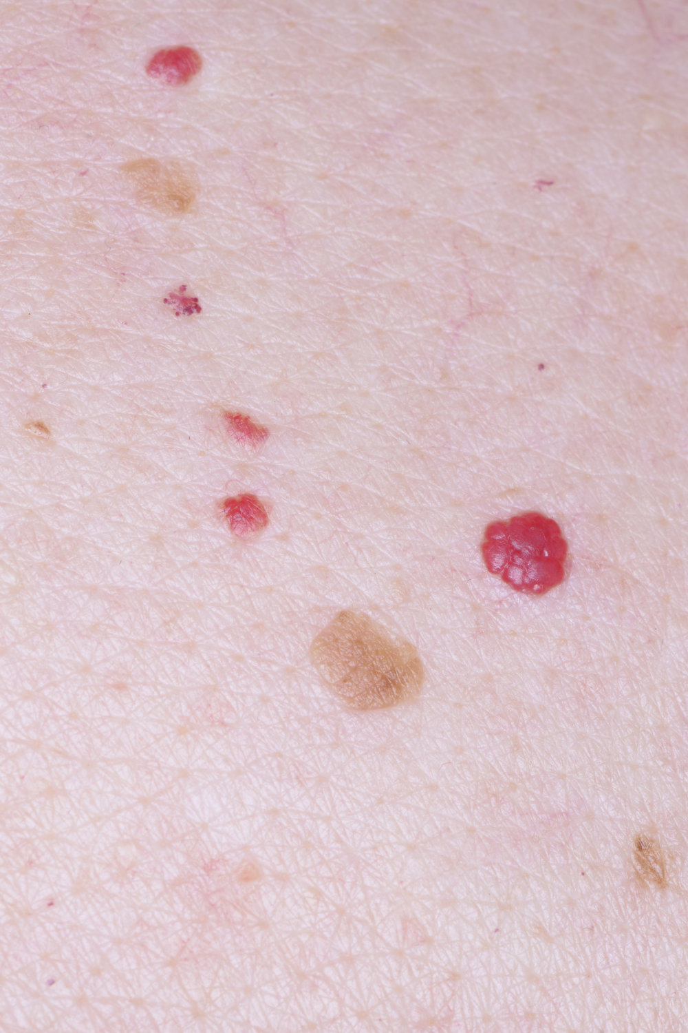 bright red cherry angiomas and freckles