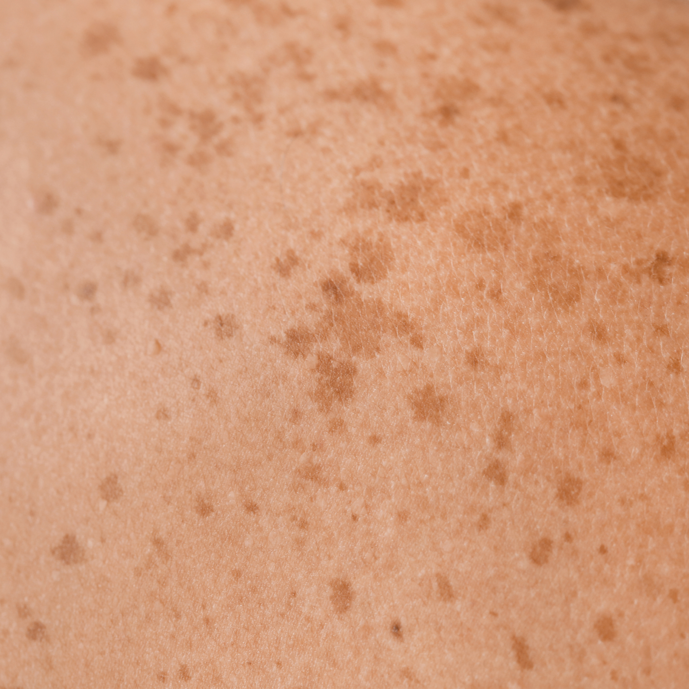 light brown pigment on fair skin