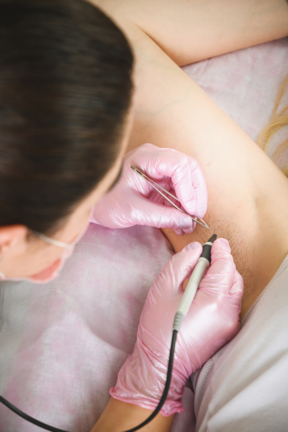 electrologists with pink gloves preforming electrolysis hair removal