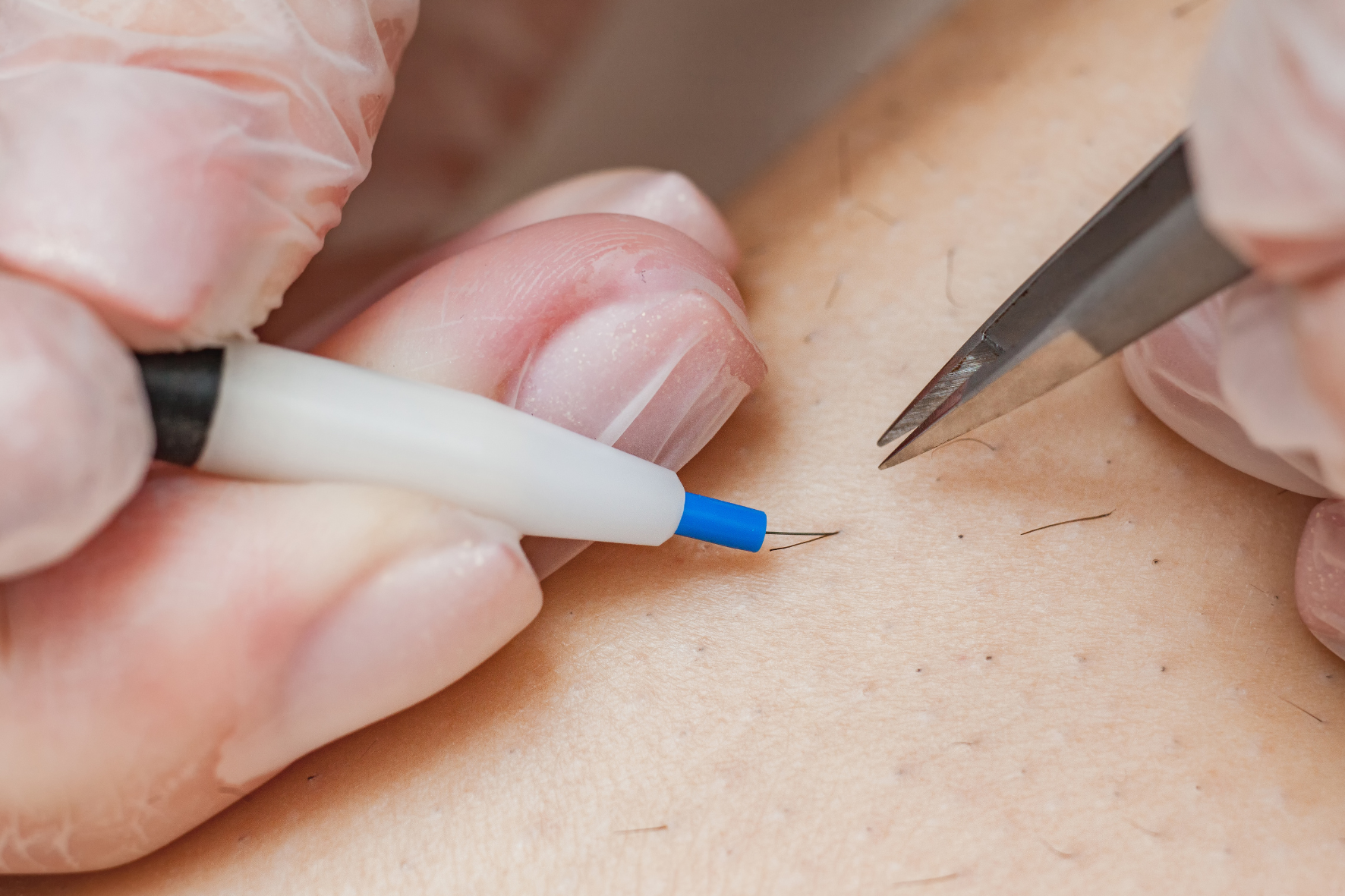 electrolysis treatment being preformed