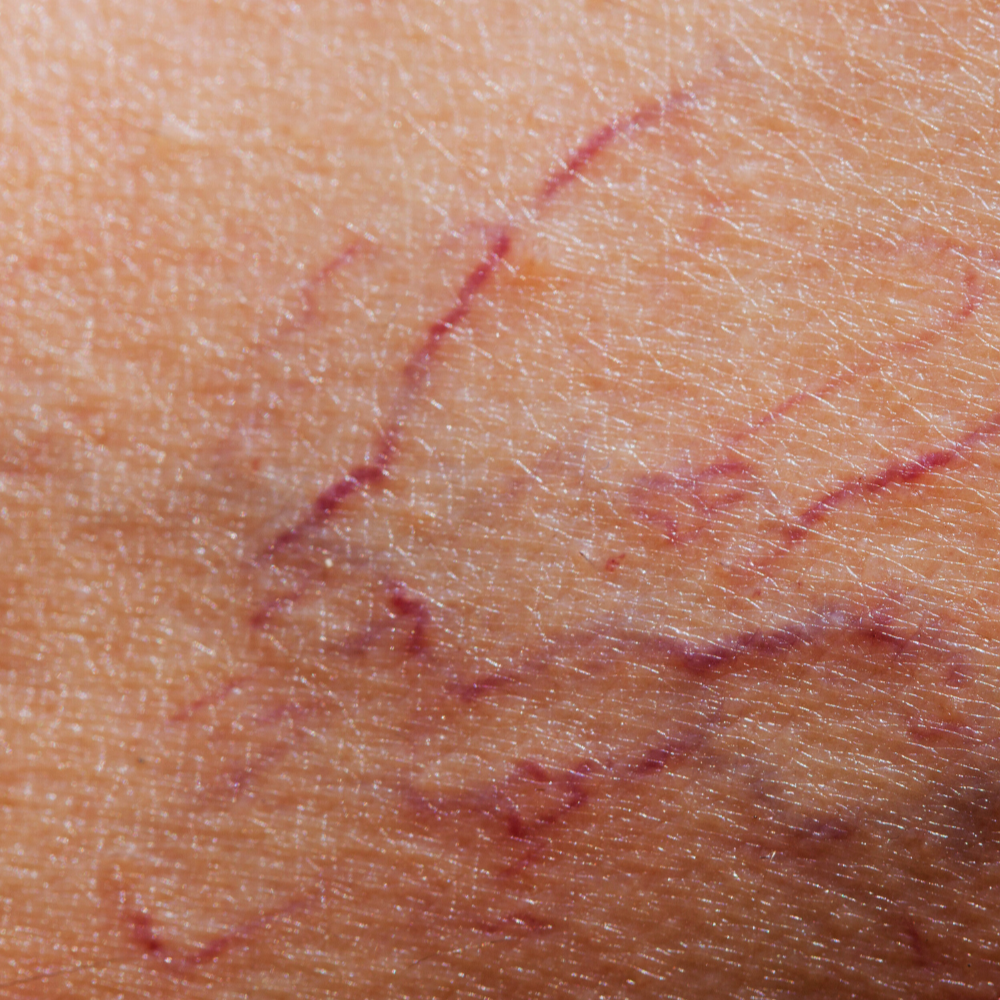 a close up of skin showing red spider veins
