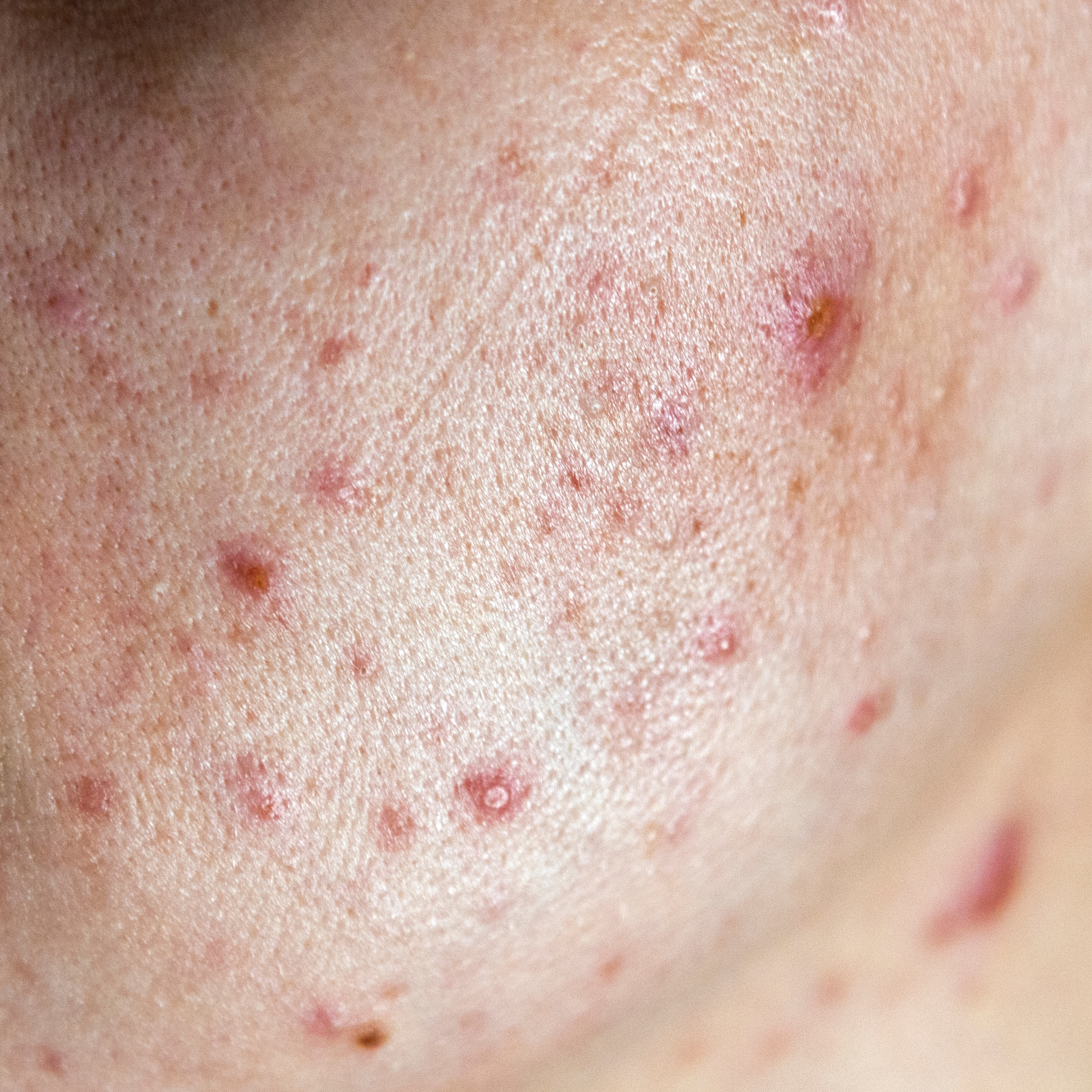 active acne breakout