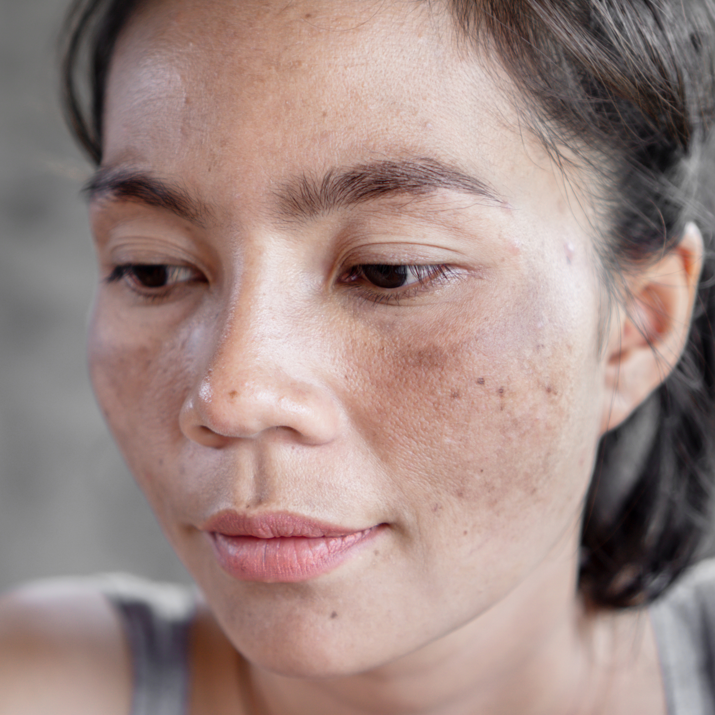 woman's face showing sun damage on cheeks in the form of freckles