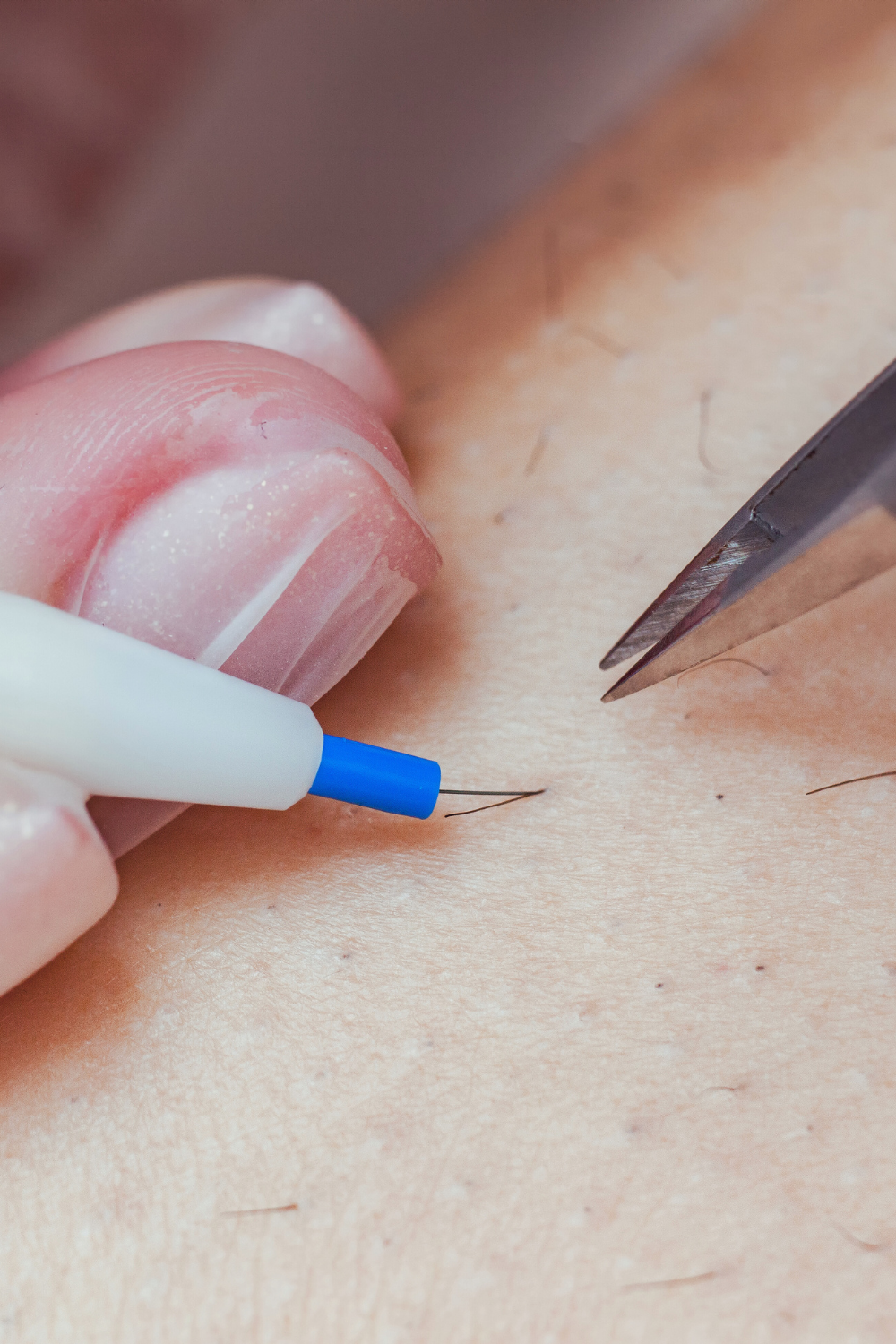 treatment of a hair follicle using electrolysis