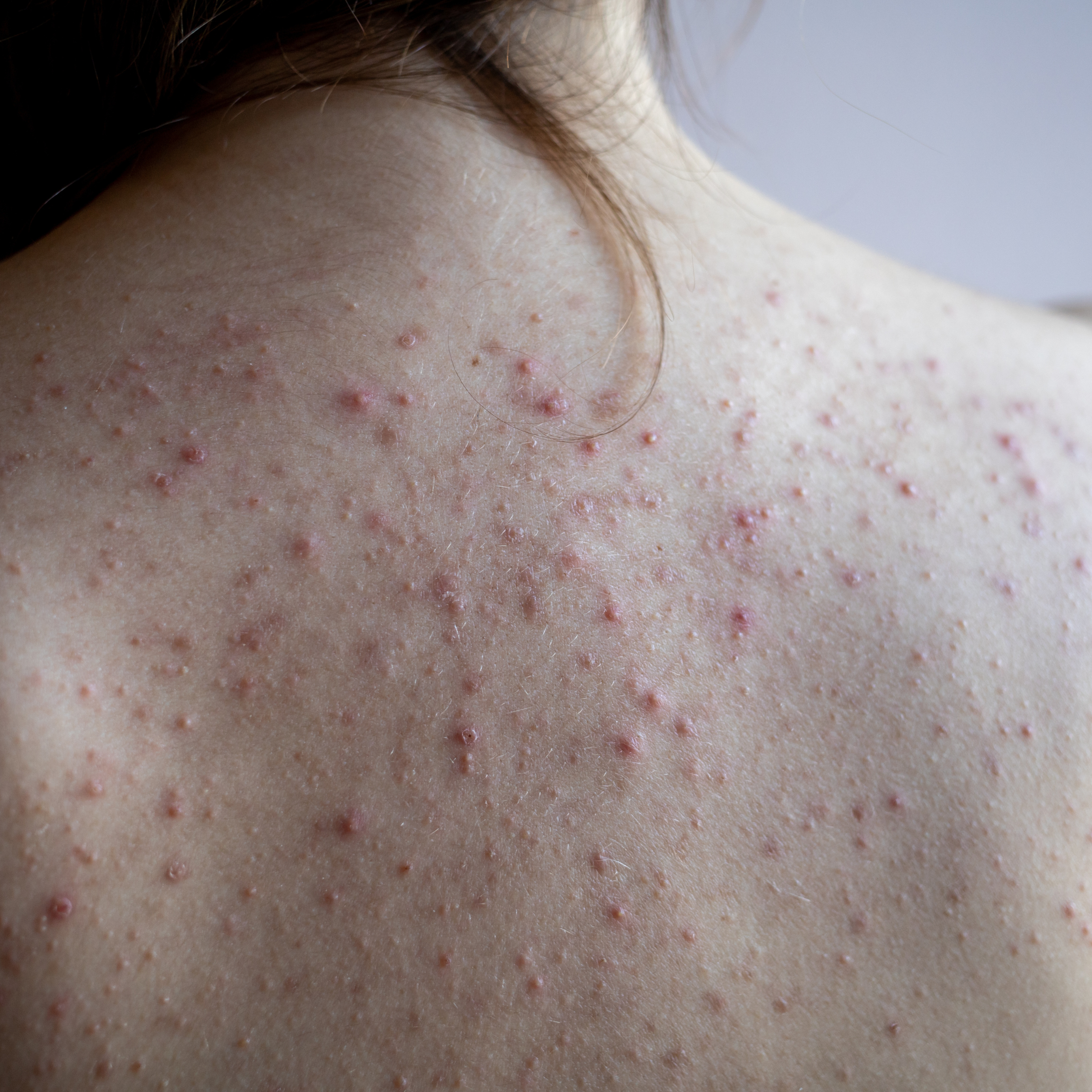 back covered in small red acne bumps