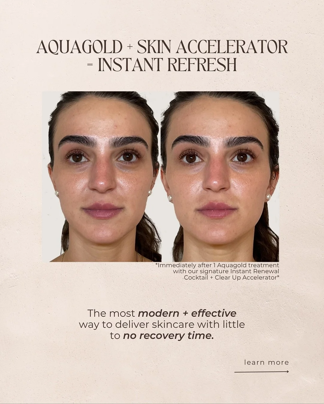 All the skincare you need, infused directly into your skin. 
This patient received an Aquagold treatment with our signature Instant Renewal Cocktail + topped it off with our ‘Clear Up’ Skin Accelerator to further boost her results.
✓ in