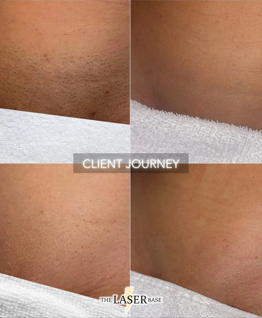 Imagine being this hair free?!

That&rsquo;s exactly what we were able to achieve for our client. 

She went from having rough stubble to having smooth, hair free skin all year round😍

Images were taken during her 1st, 3rd, 6th and 10th session. It&
