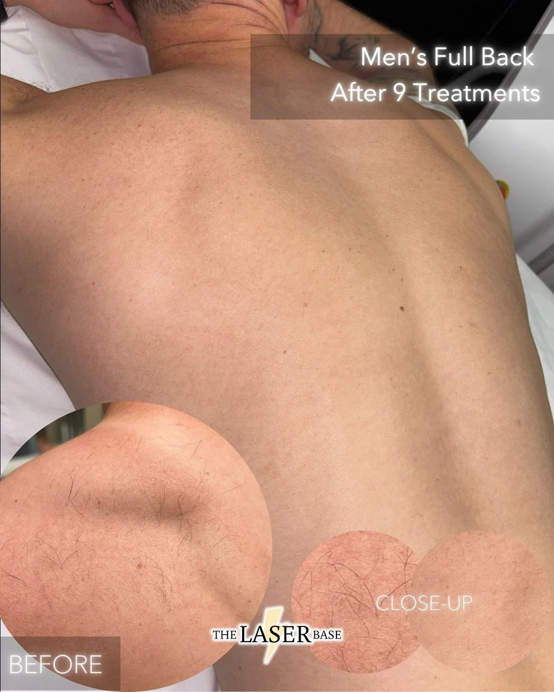 Did you know that men can have laser hair removal too? It&rsquo;s more common than you think!

A lot of men start their laser hair removal journey because they&rsquo;ve got thick, unwanted hair or they will get patches of hair around their shoulders 