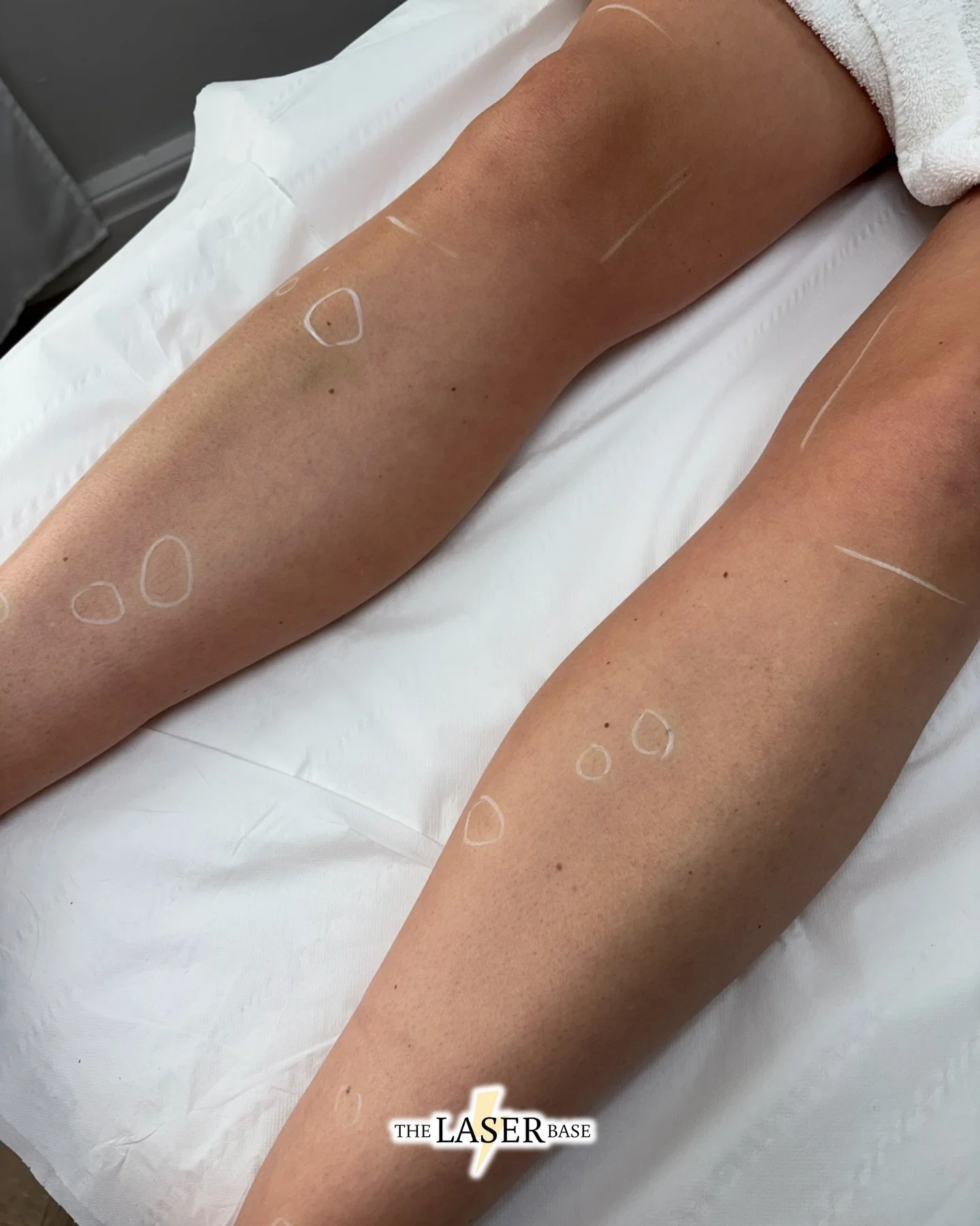 What realistic hair regrowth looks like after completing your course 💛

Our client now only comes in for top-ups as and when needed, but as you can see, the hair regrowth is minimal.

After inspection, there was only a little fluff on her knees and 