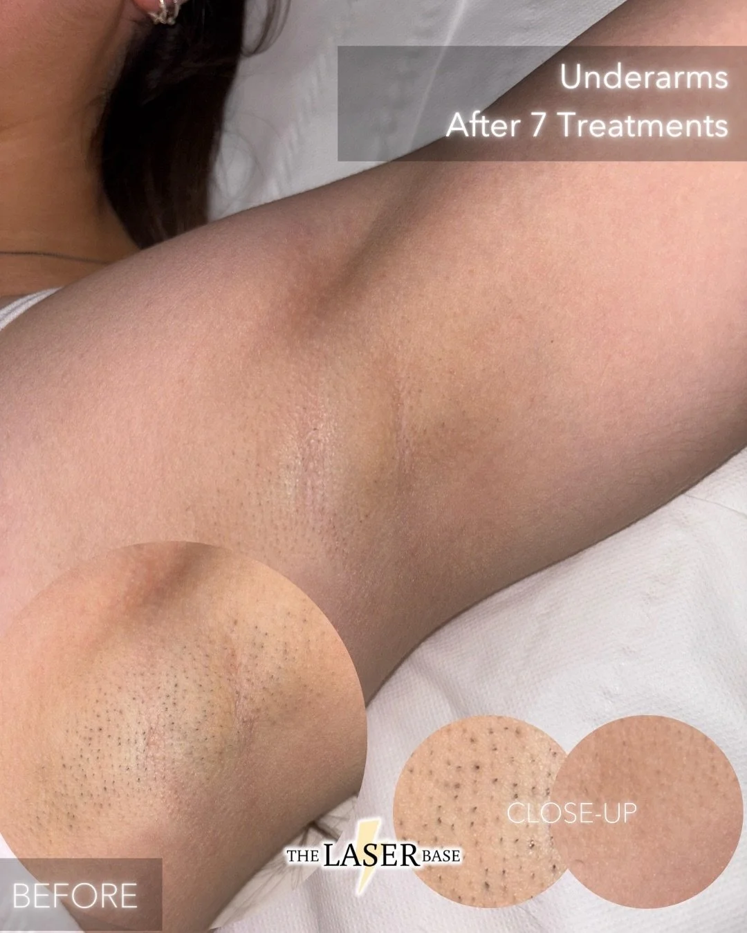 In progress ⚠️ after 7 treatments of laser hair removal for underarm and legs 😍

Our client no longer has dark stubble on her underarms or legs, which was caused by shaving. There's just a small percentage of hair left to reduce. 

She&rsquo;s on he