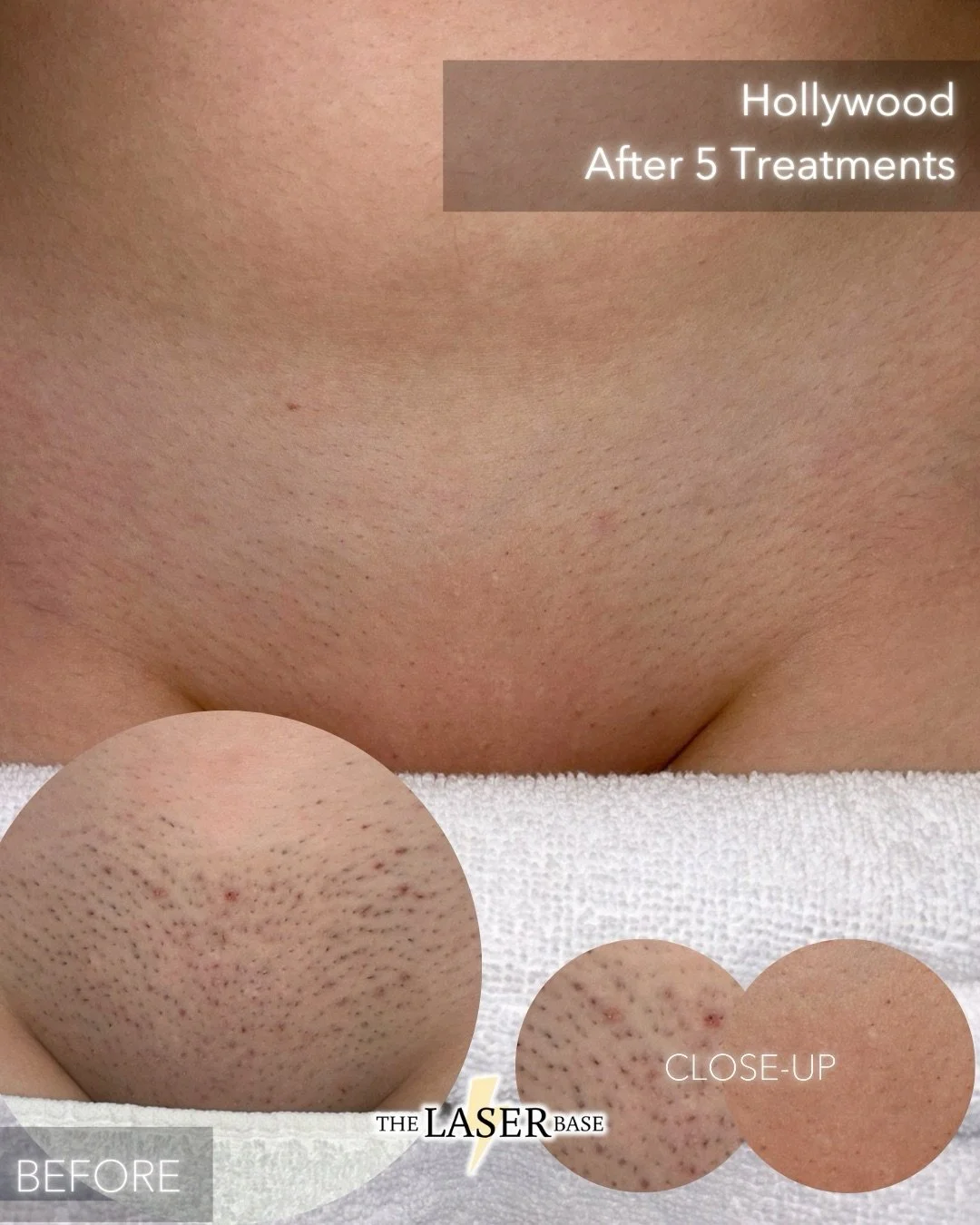 Laser hair removal doesn&rsquo;t just remove hair, it gives you back your time and energy.

Our client went from dealing with thick hair, irritation and ingrown hairs to finer hair and irritation free skin in just 5 sessions.

She doesn&rsquo;t just 