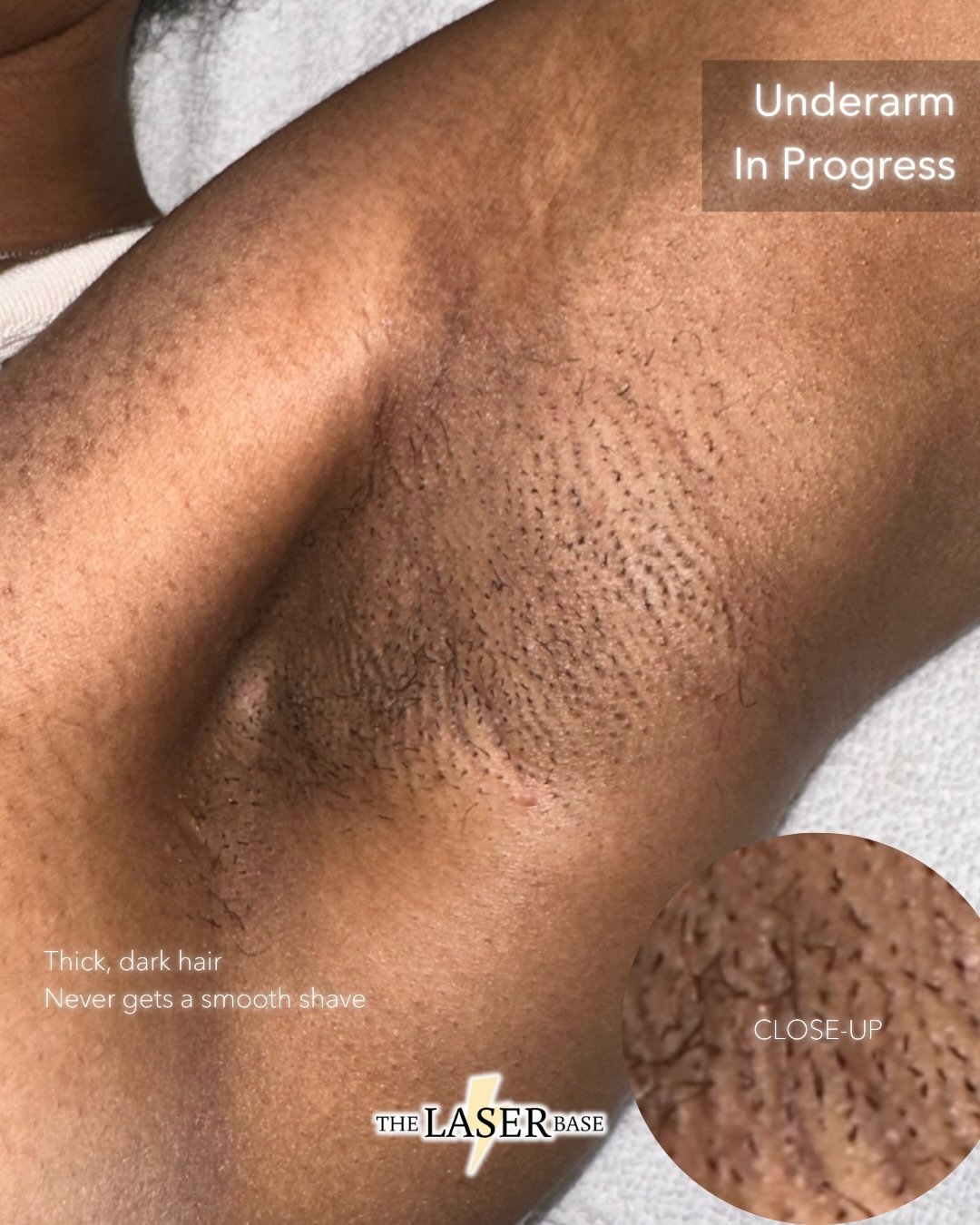 On her way to smooth skin all year round. ⚡️

Our client had dark shadows on her underarms due to constant shaving and thick hair. 

Our aim is to reduce hair thickness and improve skin texture.

And now? After 8 sessions she has only a couple of sma