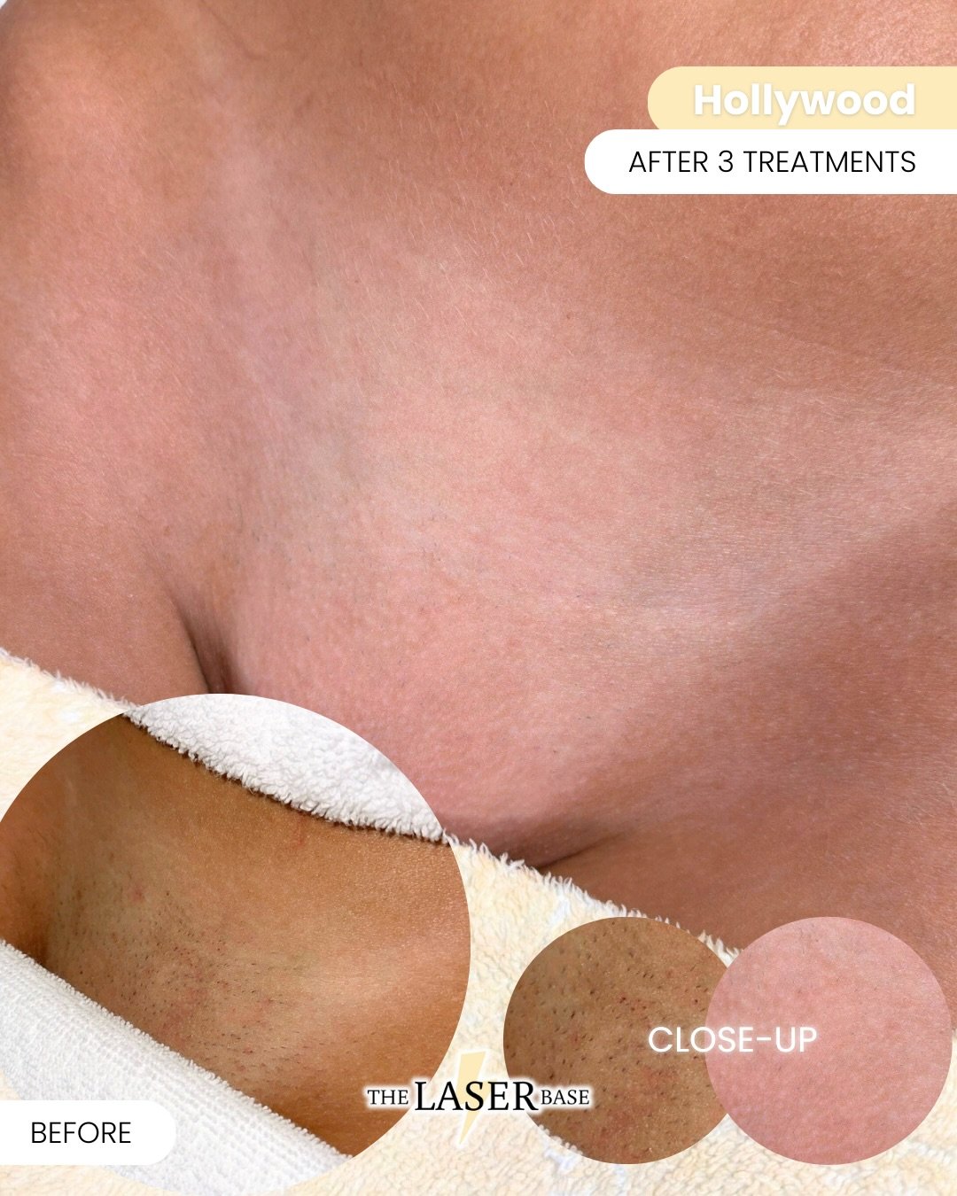 3 sessions in&hellip; and just look at that difference 👏🏼✨

Underarms + Hollywood after only THREE treatments.

The density has massively reduced, the texture has softened, and we&rsquo;ve gone from daily stubble and irritation&hellip; to smooth sk