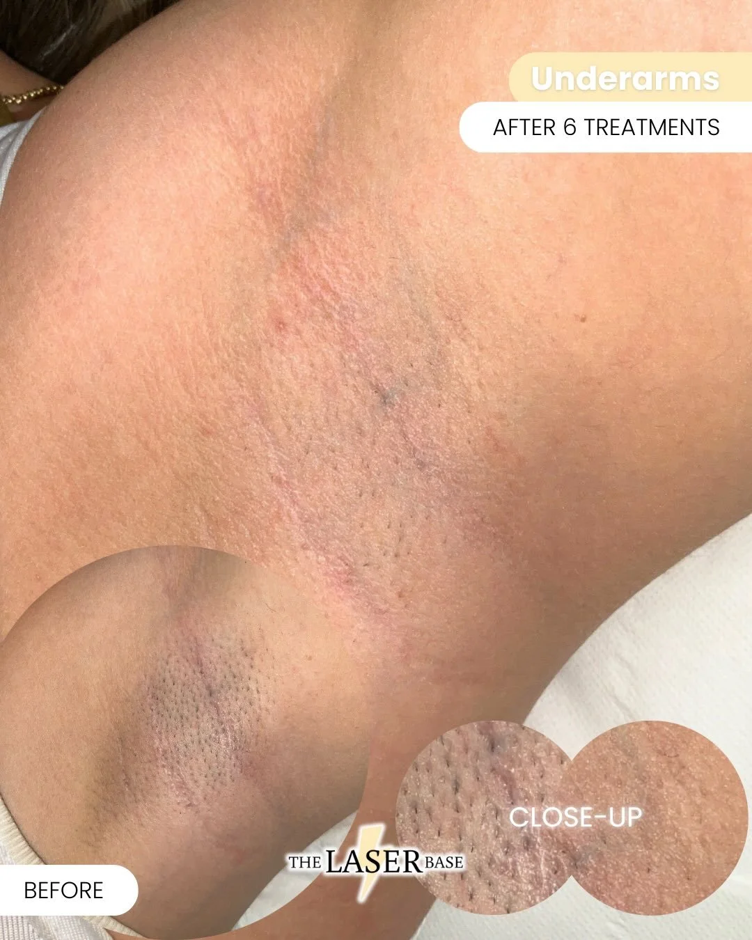 6 sessions in&hellip; and look at that difference 👏

This before &amp; after shows an Underarm + Hollywood after 6 laser hair removal sessions. You can already see how the hair has changed- going from thick, coarse growth to much finer, softer, fluf