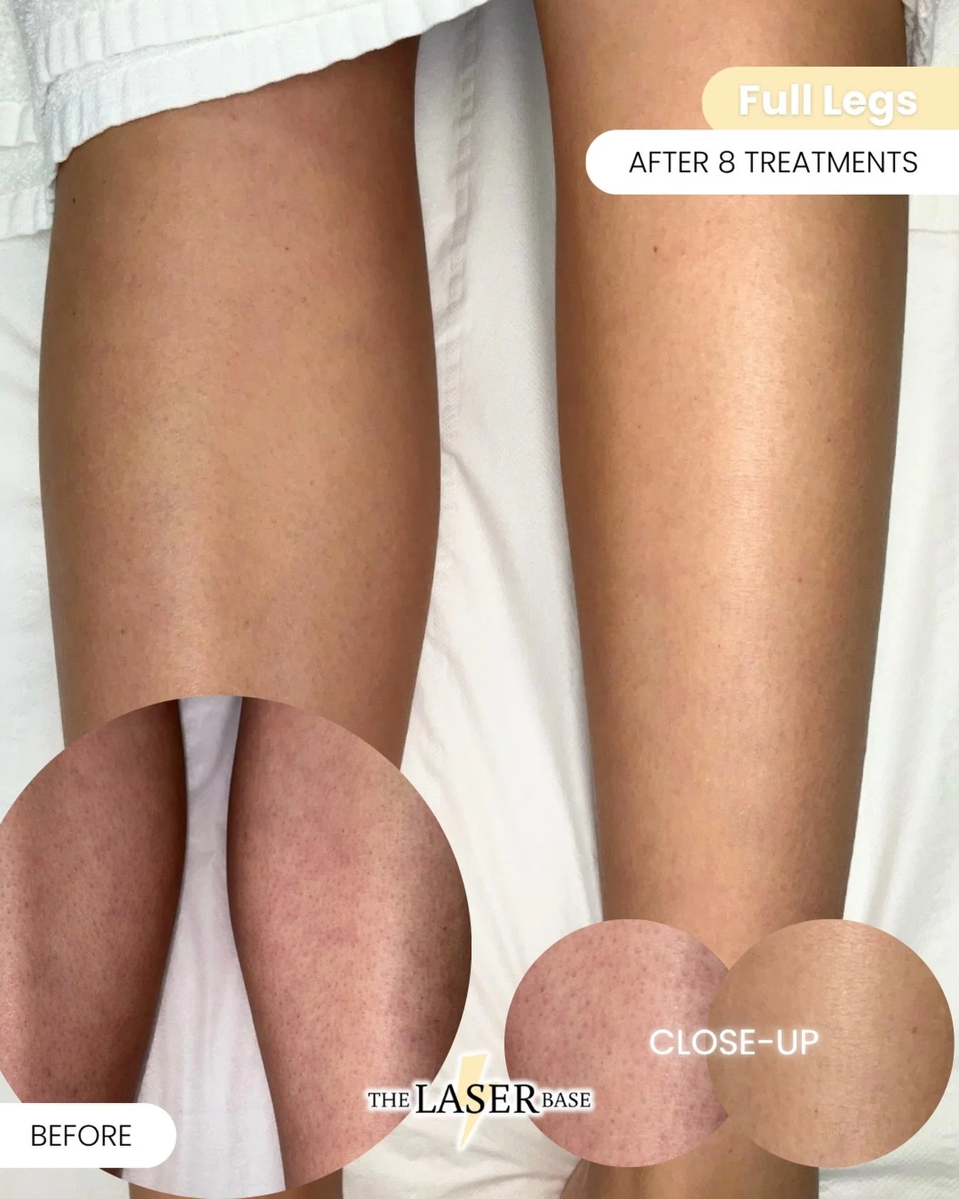 Do you struggle with strawberry legs from thick hair?

This is after 8 sessions of full leg laser - no more prickly regrowth, no more blotchy skin. Just smooth legs and a more even skin tone.

It&rsquo;s one of our most popular areas for a reason&hel