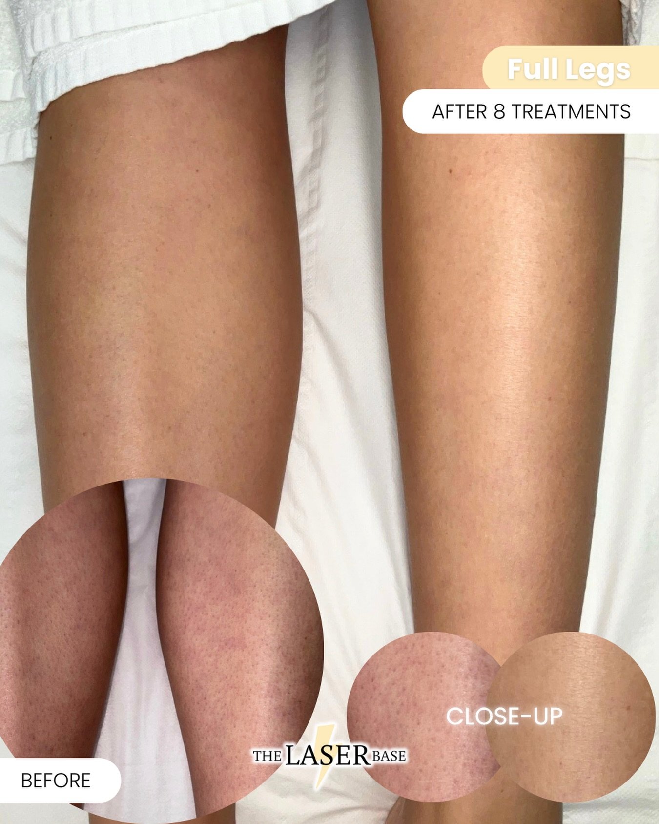 Do you struggle with strawberry legs from thick hair?

This is after 8 sessions of full leg laser - no more prickly regrowth, no more blotchy skin. Just smooth legs and a more even skin tone.

It&rsquo;s one of our most popular areas for a reason&hel