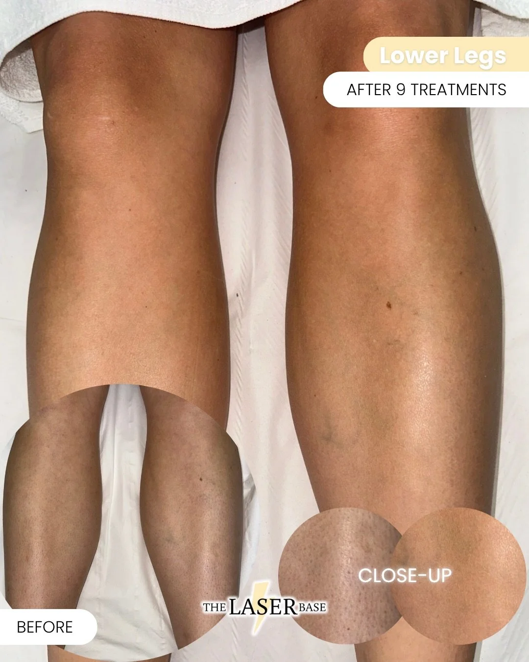 Holiday ready 👙
Underarm, Hollywood and Lower Legs - our most popular package for an easier routine ⚡️❌🪒

From uneven skin tones and thick, coarse hair to smooth, silky skin ✨

This client came to us with extremely thick, stubborn hair - the kind w