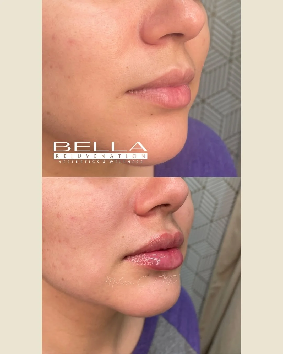 Mini: Bella Kiss💋 ✨
Half the syringe💉, full-on obsession.